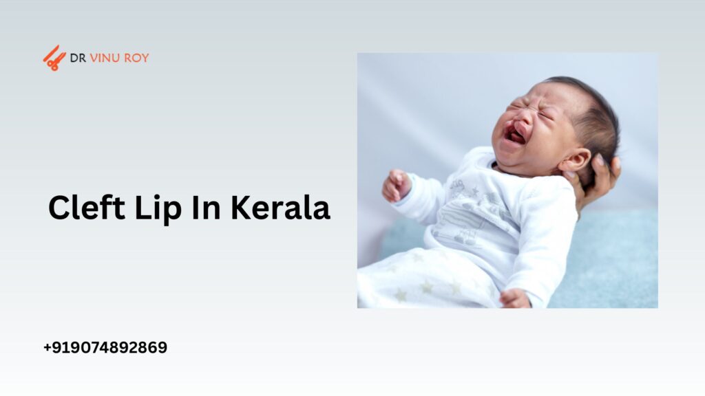 cleft lip in kerala