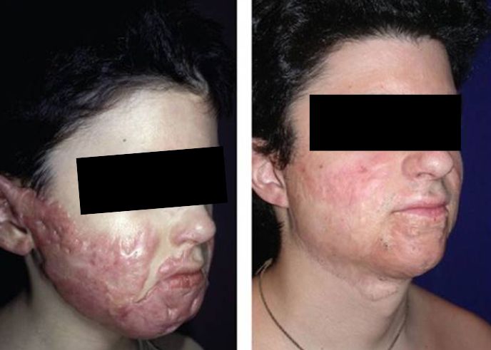 Burn Reconstruction and Scar Management