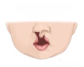 Cleft Lip and Palate Repair