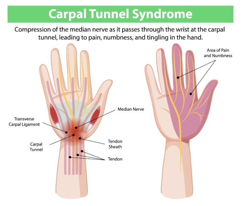 carpal tunnel syndrome surgeon in Thrissur