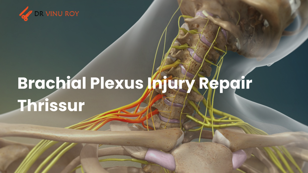 brachial plexus injury repair Thrissur