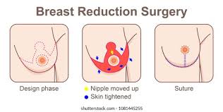 Before and after comparison showing breast size and contour changes following breast reduction surgery.