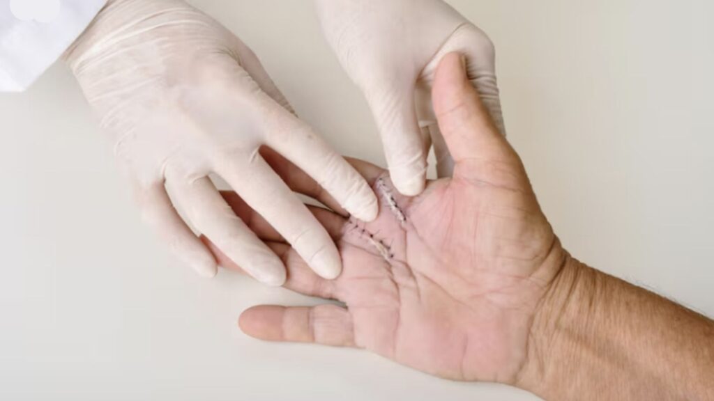 Post-operative hand with sutured palm wound after hand injury repair surgery