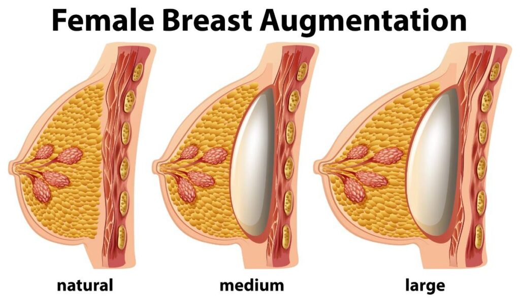 Who is a Candidate for Breast Augmentation? Illustration showing different breast implant sizes and breast augmentation options used to evaluate candidacy for breast augmentation surgery.