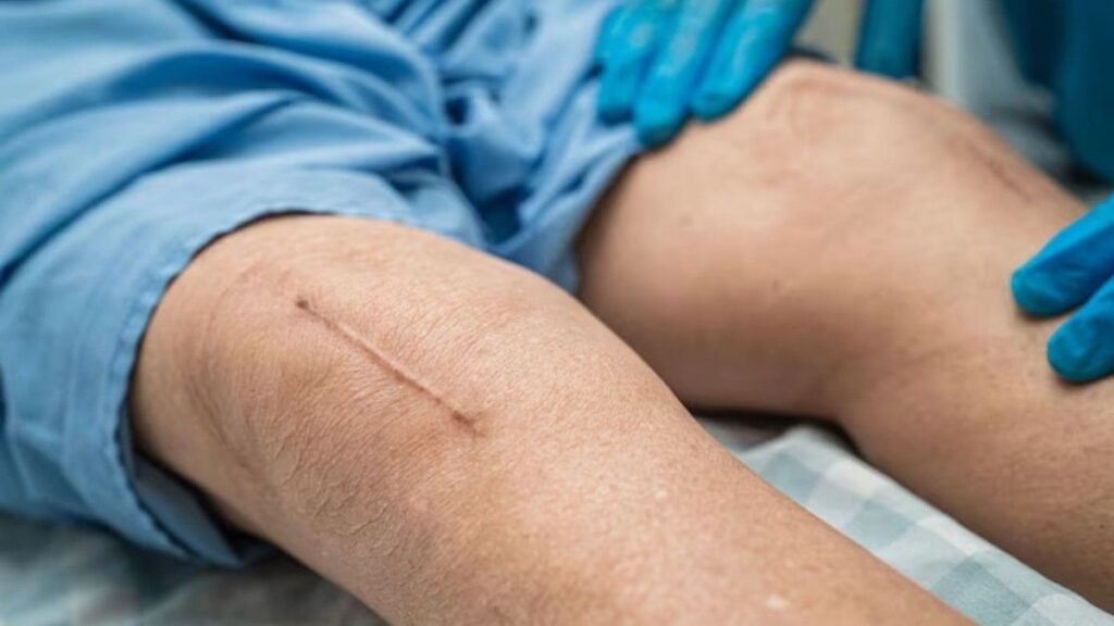 Scar Correction After Traumatic Injuries showing a healed linear scar on the knee being evaluated by a healthcare professional during a reconstructive surgery follow-up consultation.